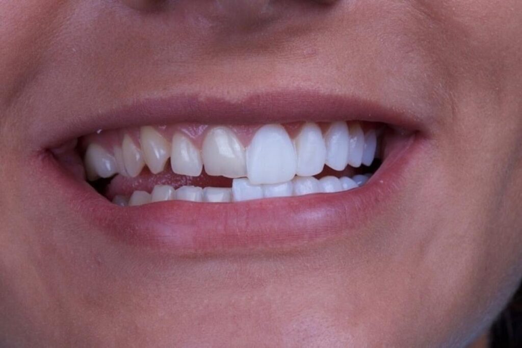  لمینت دندان چیست و چگونه کار می‌کند؟