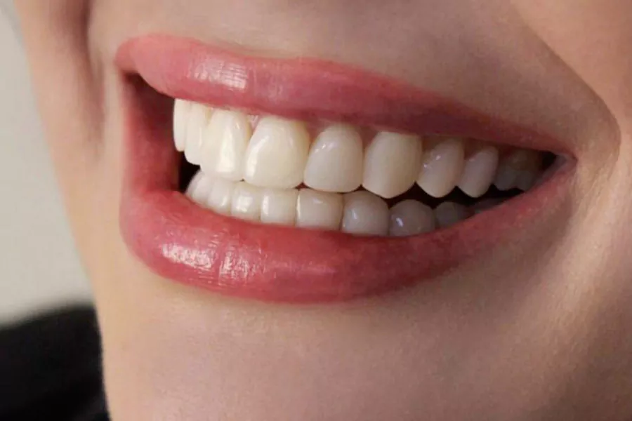 لمینت سرامیکی دندان چیست؟
