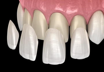 مزایای ونیر برزیلی (Veneer) در زیبایی لبخند و چگونگی اجرای آن