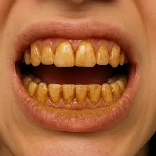 علت زرد شدن دندان چیست؟