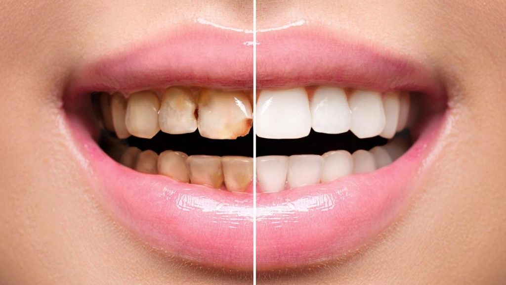 ترمیم دندانهای جلویی؛ چه زمانی روکش لازم است و چه زمانی کامپوزیت؟